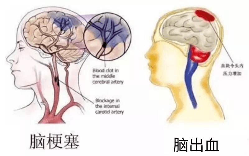 脑梗最新治疗方法的研究与应用进展