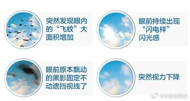 飞蚊症治疗获重大突破，视界重塑新篇章